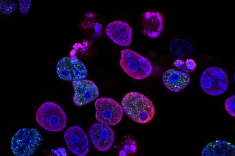 BRCA Gene Mutations and Hypermethylatio