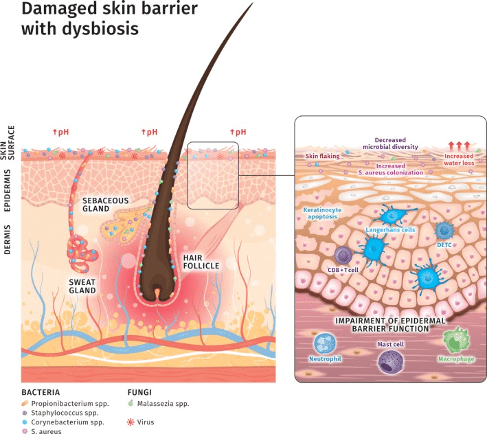 Damaged skin barrier with dysbiosis.